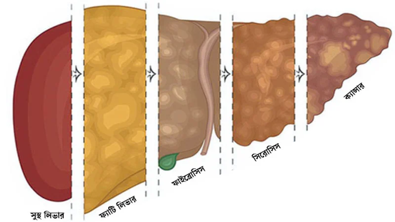 লিভার সুস্থ রাখুন ১০ উপায়ে